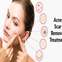 Skinlite Cream for Melasma, Hyperpigmentation, Whitening, Lightening - 20g - Image 3